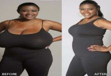 Breast Reduction Surgery Cost And Duration Required Breast Reduction Surgery Cost