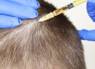 How Significant Donor Areas For Hair Transplant Are?