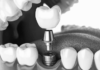 Renew Your Shedding Teeth With Mini Dental Implants! Shedding Teeth