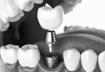 Renew Your Shedding Teeth With Mini Dental Implants! Shedding Teeth