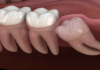 Check Out The 5 Actual Benefits Of Wisdom Teeth Removal teeth surgery