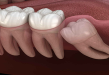 Check Out The 5 Actual Benefits Of Wisdom Teeth Removal teeth surgery