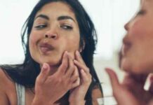 What is the Best Treatment for Pimples? What is the Best Treatment for Pimples