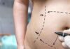 The Lowdown on Laser Lipo: What to Expect from This Procedure The Lowdown on Laser Lipo