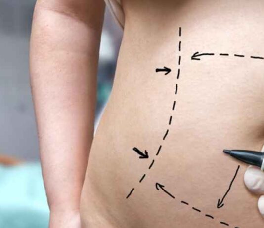 The Lowdown on Laser Lipo: What to Expect from This Procedure The Lowdown on Laser Lipo